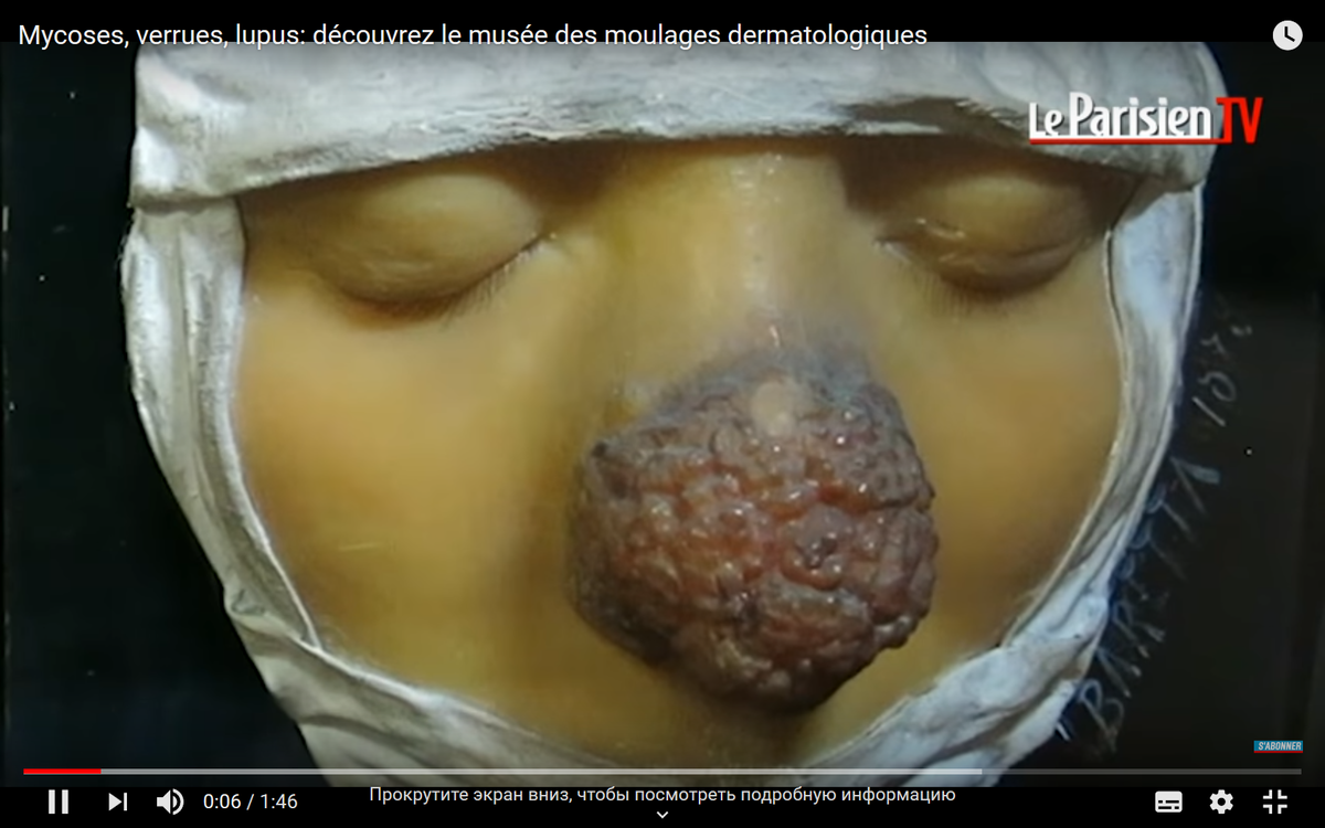 1885. Vaska mulāžas muzejs. ASV, Sentluisa  hospitāle 